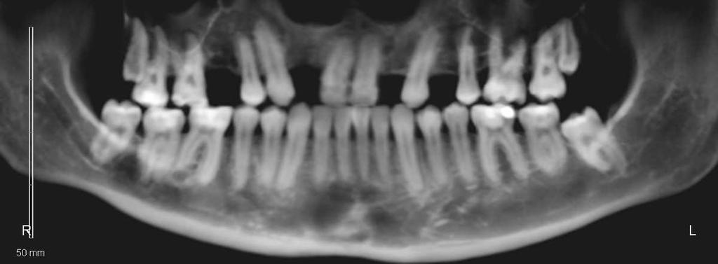 Discussão 147 do enxerto, fazendo com que os dentes adjacentes à fissura não tivessem suporte ósseo nas faces radiculares voltadas para a região da fissura (Fig. 35).