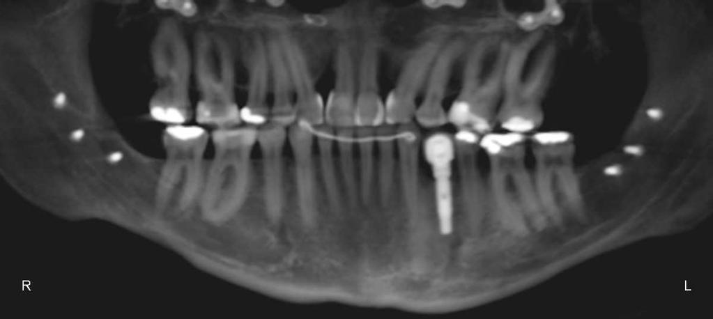Um paciente apresentou reabsorção vertical do enxerto ósseo alveolar bilateral na face