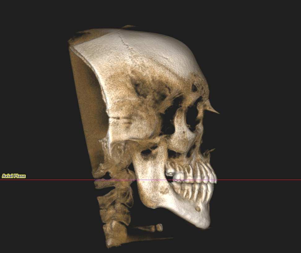 80 Material e Métodos Para cada imagem craniofacial reconstruída, foi feita a orientação da cabeça seguindo a padronização descrita abaixo, e todos os cortes seguiram esta orientação: na visão
