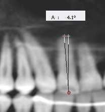 88 Material e Métodos Figura 28 - Angulação. Para cada dente avaliado foram anotadas cinco variáveis: coroa anatômica, coroa clínica, ponto EV, inclinação e angulação.