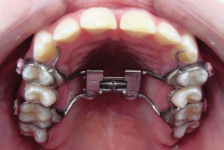 Todos foram tratados com o procedimento de expansão rápida da maxila, sendo submetidos ao mesmo protocolo de ativação, por meio dos aparelhos expansores dentossuportados Hyrax (Fig.