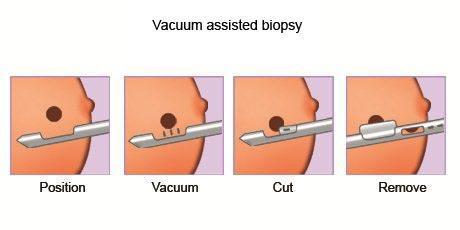 Biópsia percutânea vácuo-assistida (Mamotomia)