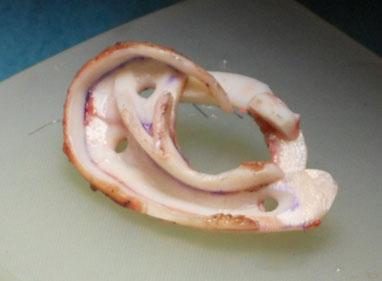 Exemplo de um arcabouço de orelha reconstruído a partir de cartilagem retirada da costela Você trabalha com próteses de orelha? Quando está indicado o uso de próteses de orelha?