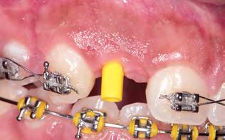 Utilização do medidor de altura de sulco para implantes CM (Sistema Neodent) (B).