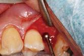 ELEVAÇÃO DE ALVÉOLO (ABORDAGEM CRESTAL) Para procedimentos como osteotomia do seio maxilar com abordagem da crista alveolar e ajustes do local de preparação para implante.