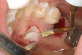 dentes; 0,8 mm de espessura Revestimento TiN Gume afiado 0,5 mm de espessura Revestimento TiN Pontos a 3 mm, 6 mm e 9 mm da extremidade da ponta Três