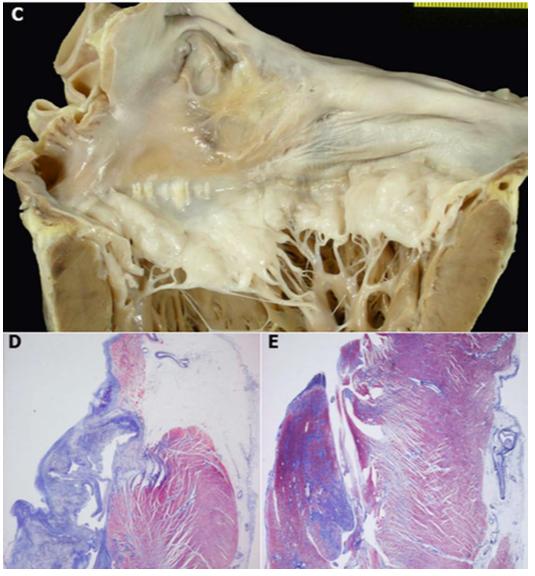 PVM e risco de MSC Fisiopatologia: - Tracção nos músculos papilares - Lesões endocárdicas Fibrose e por realce fricção tardio -