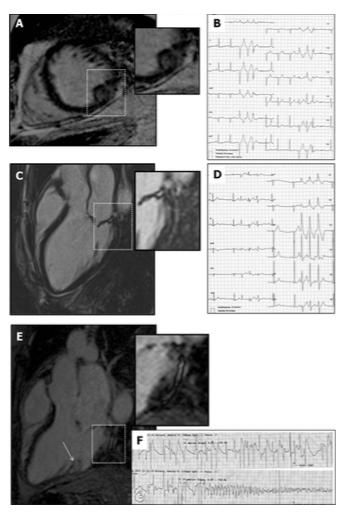 PVM e risco de MSC Fisiopatologia: - Tracção nos músculos papilares - Lesões endocárdicas Fibrose e por realce fricção tardio -