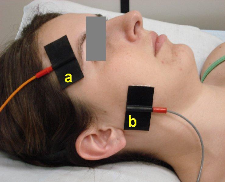 39 Figura 6 - Os eletrodos da EEAV posicionados sobre o músculo temporal anterior (a), sobre o músculo masseter (b) e o eletrodo dispersivo (c) posicionado na região cervical e torácica alta.
