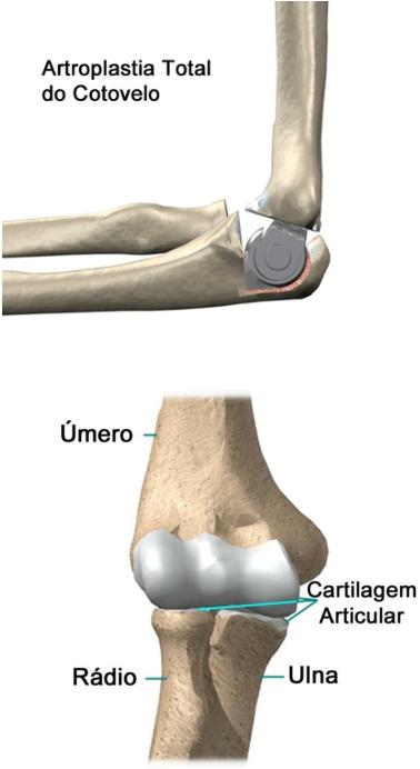 Artroplastia de cotovelo Introdução A substituição da articulação do cotovelo pode tratar efetivamente problemas desencadeados pela artrite.