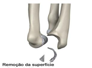 A prótese não cimentada tem uma trama de pequenos buracos que ancoram a prótese ao osso.