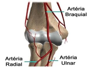 Soltura A principal razão da falha da artroplastia é se houver soltura do metal ou do cimento no osso. Uma soltura pode causar dor.