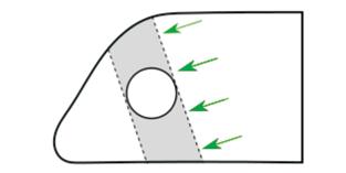 A TC, para além do defeito no septo cartilagíneo, revela ausência de alterações inflamatórias crónicas naso-sinusais. FIGURA 3 Caso Clínico 2 - Perfuração septal anterior com cerca de 1,5cm.