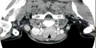 Al ingreso seguía terapia de mantenimiento con corticoides e Interferón.