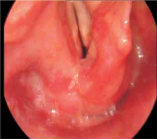 Durante a cirurgia com Laser CO 2 foi necessário a utilização de uma cânula de aspiração associada a um electro cautério, para assegurar um melhor controle da hemorragia (Figura 4) FIGURA 5 Follow up