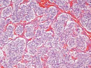 FIGURA 7 Aspecto microscópico do tumor com padrão padrão em ninhos, Zellballen (HE, 200X). FIGURA 9 Imunohistoquímica mostrando negatividade para citoqueratina (200X). invasão perineural.