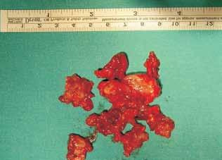 El resultado definitivo de la pieza quirúrgica es informado como carcinoma adenoide quístico (Figura 4) por lo que en comité multidisciplinario entre el Servicio de Oncología Radioterápica y