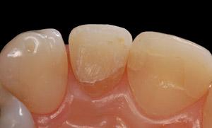 confeccionada após a realização de uma cirurgia estética periodontal. Figura 1.