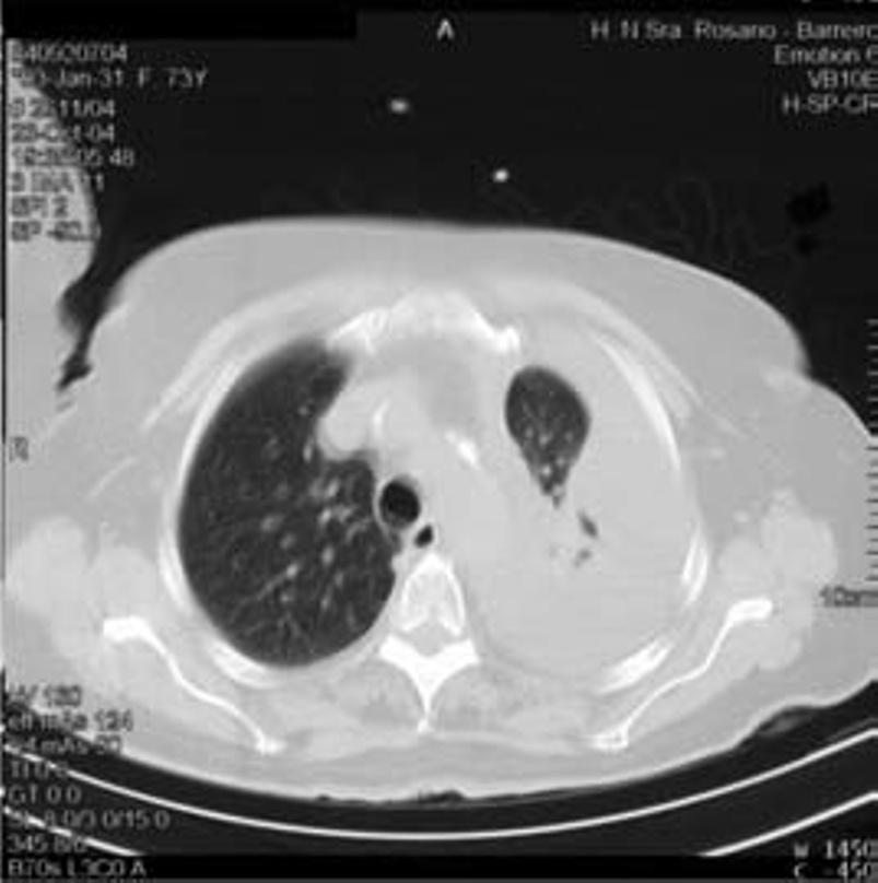 Fig. 2 TAC torácica de 09/10/2004 pedida na primeira consulta de pneumologia Fig. 3 Ecografia hepática de 16/10/2004 (exclusão de LOE) lavado brônquico com ex.