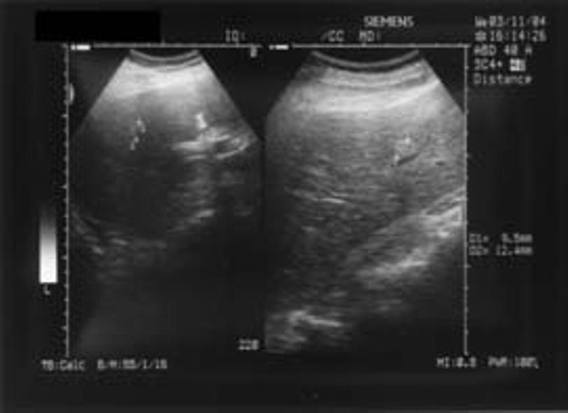 Fígado com dimensões conservadas, com 3 imagens focais compatíveis com hemangiomas. Sem outras alterações. Fez ecografia hepática que foi compatível com a existência de hemangiomas (Fig. 3).