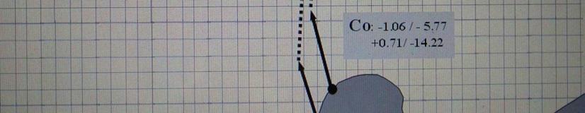 Após a terapia com bionator, apresentaram alteração vertical estatisticamente significante os pontos cefalométricos: Ag, InfGo,