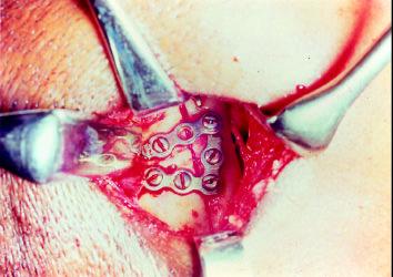 Fotografia de perfil evidenciando um retroposicionamento mandibular em conseqüência da fratura bilateral de côndilo. Figura 2.