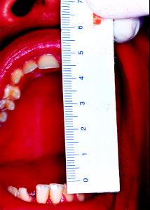 A incisão sub-mandibular oferece melhor campo cirúrgico facilitando a fixação de miniplacas de 2.0mm e ainda a recaptura do côndilo quando há a necessidade de realizar a osteotomia vertical do ramo.
