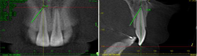 apex on intersection of axial cursor with coronal and sagittal cursors.