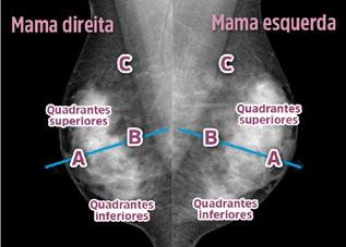 Unidade V Técnica de Realização da Mamografia Aula 3 A Figura 58 utiliza as mesmas radiografias da Figura 57, mas faz a correlação com as linhas azuis, que dividem a mama em metade superior e