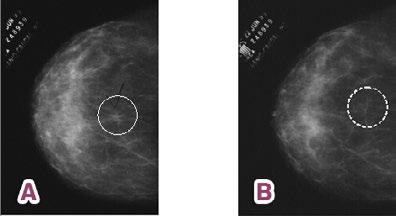 Unidade V Técnica de Realização da Mamografia Aula 5 A escolha do sentido da rotação (lateral, medial, superior, inferior) vai depender da localização da lesão e principalmente do tipo de mama, pois
