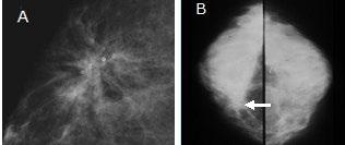 e) Distorção arquitetural Uma distorção arquitetural é caracterizada, na mamografia, por espículas divergentes, partindo de um ponto na forma clássica, mas pode também se apresentar como a perda do