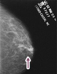 Unidade II O câncer de mama Aula 1 f) Ducto único isolado É um único ducto, com calibre aumentado, na região retroareolar, conforme exemplo na Figura 14.