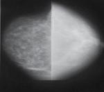 Unidade III A mamografia Aula 1 3. Requisitos técnicos Nas Figuras 21 e 22, estão representados, respectivamente, a escala de contraste e o contraste radiográfico.
