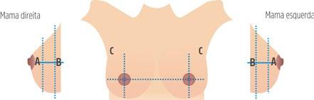 Unidade V Técnica de Realização da Mamografia Aula 2 se estiver em C, o quadrante será o inferior lateral e se estiver em D, o quadrante será o inferior medial.