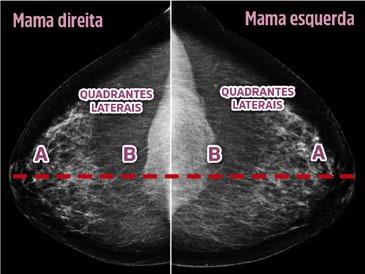 Unidade V Técnica de Realização da Mamografia Aula 3 distância da papila até o ponto mais posterior do filme na incidência CC, conforme ilustração na Figura 50.
