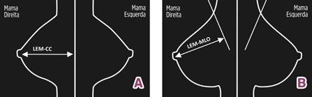 Quadrantes laterais e mediais, conforme divisão da linha imaginária vermelha (do mamilo até a porção posterior da radiografia).