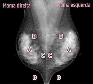 Unidade V Técnica de Realização da Mamografia Aula 3 Os critérios de qualidade utilizados na avaliação do posicionamento na incidência MLO são os seguintes: O músculo peitoral maior tem de ser visto,