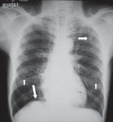 Pulmão RJ vol.13(3) 2004 pulmonares em portador do vírus HIV e discutem o diagnóstico diferencial.