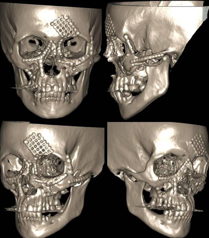 O diagnóstico das fraturas panfaciais é feito por meio de exame clínico e imaginológico.