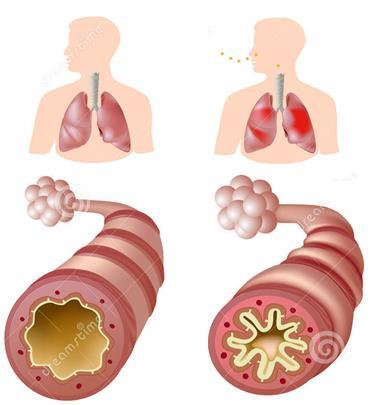 brônquica sibilos Resposta inflamatória intensa Infiltrado eosinofílico Quadro conhecido como: