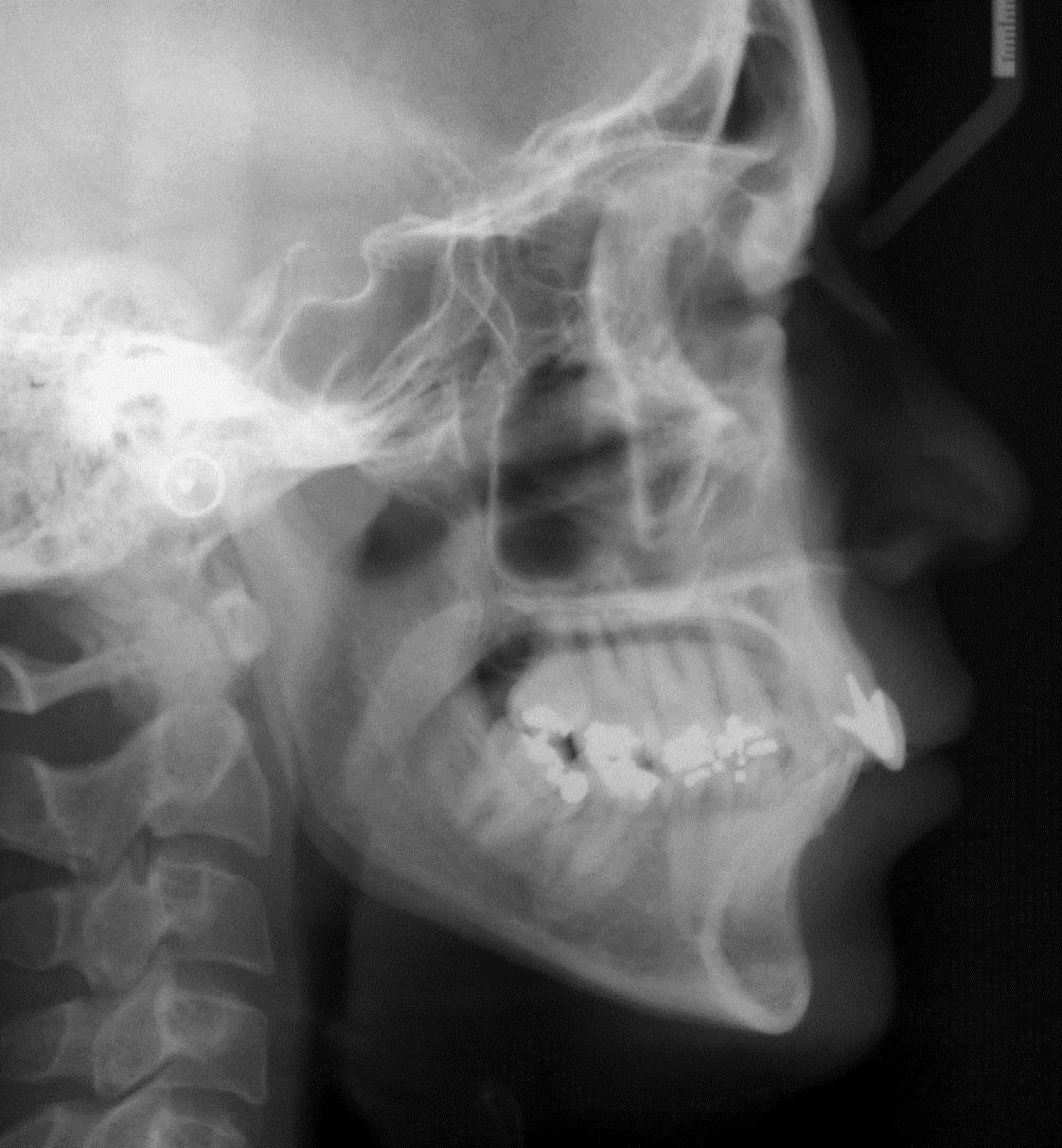 13 Na telerradiografia observa-se os incisivos superiores suavemente protuídos e vestibularizados e os