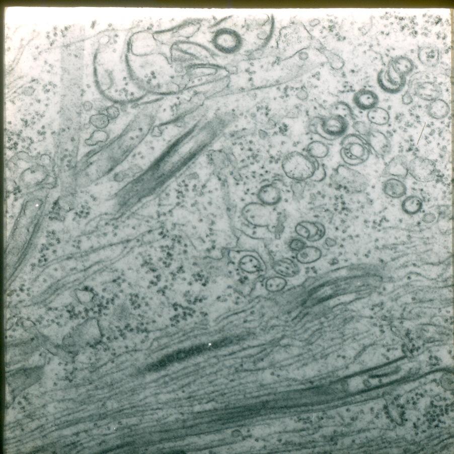 B A Figura-1- Visualização das partículas filamentosas flexuosas (A) e corpos de inclusão viral do tipo cata-vento (B) em tecido de planta infectada por PVY. 2.