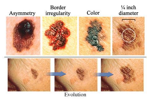 7 1.4. Diagnóstico O melanoma geralmente é diagnosticado através da avaliação clínica da lesão pelo médico.