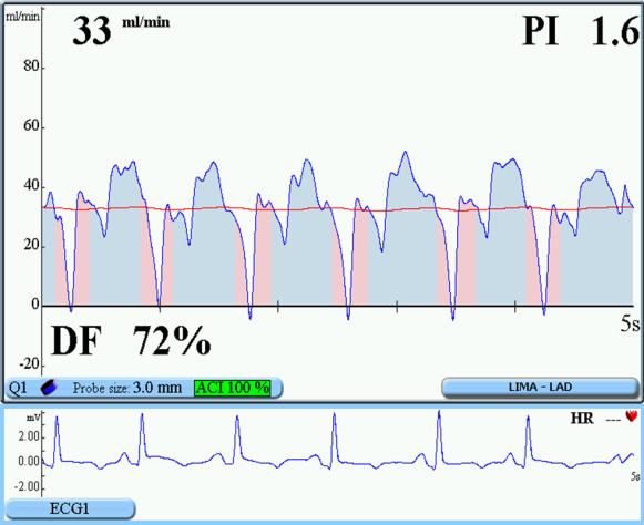 Resultados 53 Figura 7. Fluxometria do enxerto ATIE IVA; Fluxo: 33 ml/min; PI: Índice de pulsatilidade; DF: Fração diastólica. Não ocorreram complicações no intra-operatório.