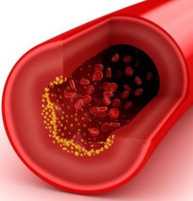 Antocianinas na Saúde Cardiovascular A aterosclerose é uma doença inflamatória crônica e estudos prévios demonstraram que a antocianina inibe tal doença.