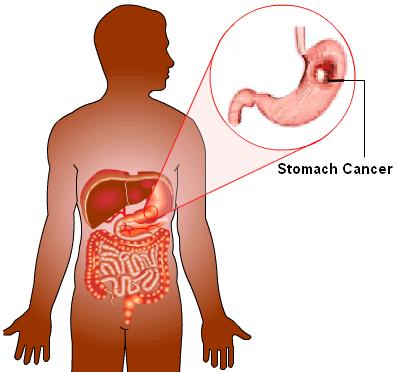 EXAME DO ESTÔMAGO Para diagnosticar o câncer de estômago é preciso levar em conta os sintomas e os possíveis fatores de risco.