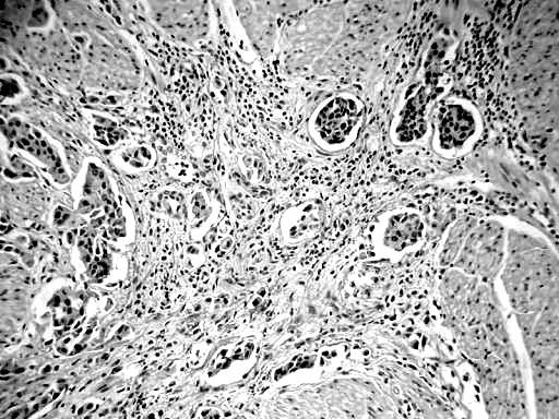 30 Invasão linfovascular (LVI) A invasão linfovascular atualmente é alvo de intensa investigação devido a sua importância prognóstica comprovada em diversos tumores sólidos (53, 81-83).