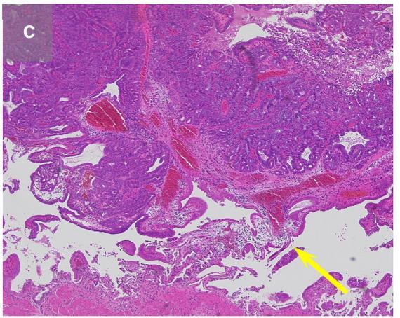 Adenocarcinoma 13 mm