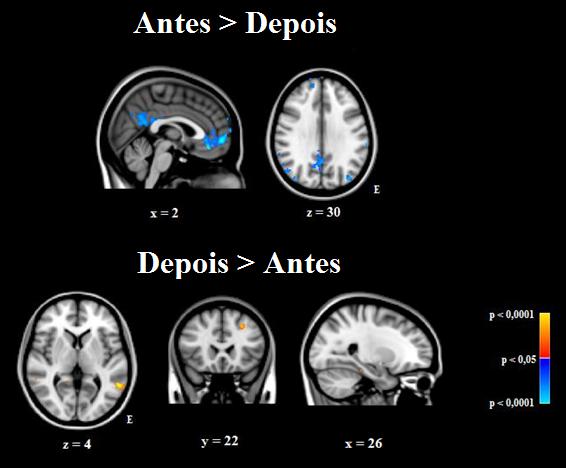 anterior, cíngulo posterior, córtex pré-frontal medial, lobo parietal inferior bilateralmente, e pré-cuneus.