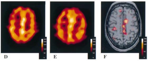 Figura 20 - Imagens SPECT utilizando ECD- 99m Tc de um paciente com convulsões intratáveis não-lesionais na zona extratemporal. (D) imagem ictal (E) imagem interictal (F) SISCOM.